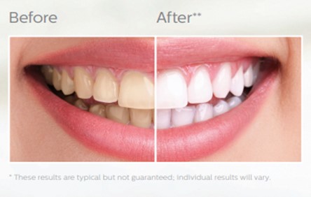 Zoom! Whitening - Cobain Orthodontics | Lafayette CA